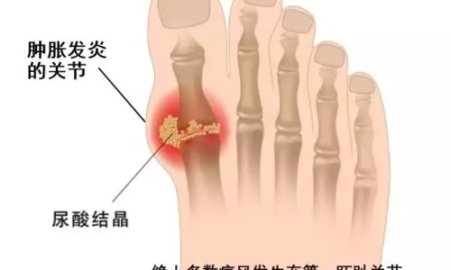 关节风湿治病原因-关节性风湿病症状网-分享风湿性的关节炎是什么症状，关节性风湿病症状表现知识库